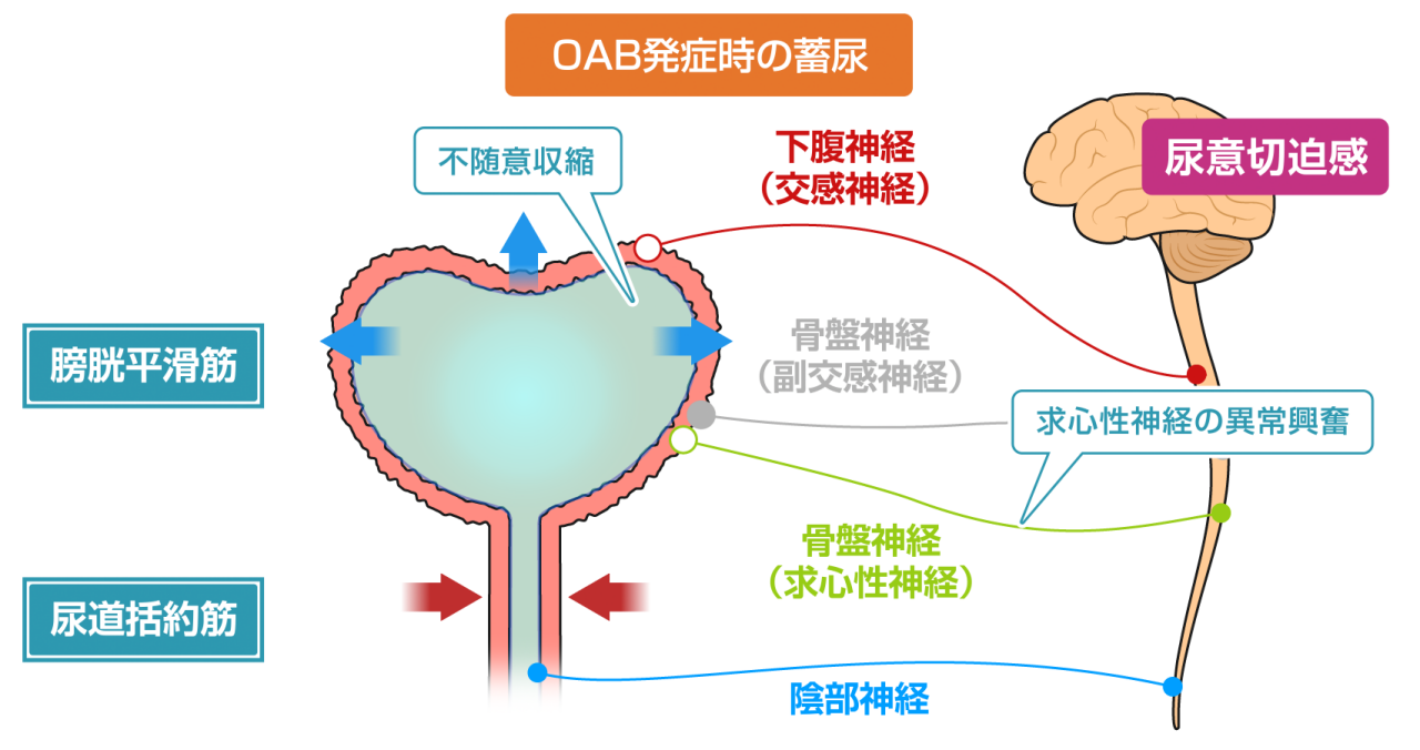 図2　正常時とOAB発症時の膀胱の働き_OAB発症時の蓄尿