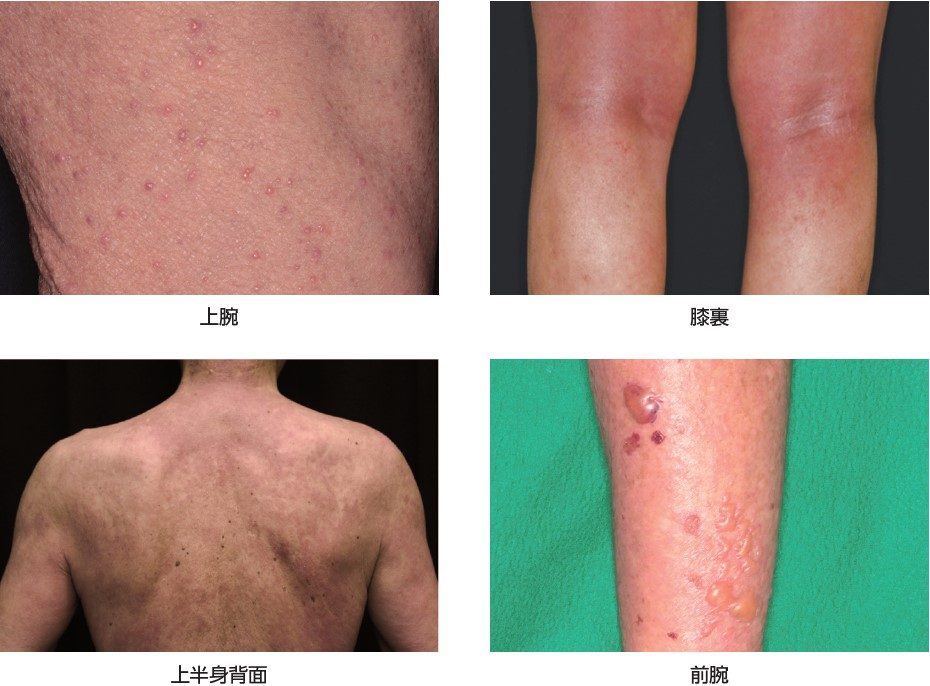 皮膚反応及びそう痒症_臨床試験（国内）で発現した皮膚反応例