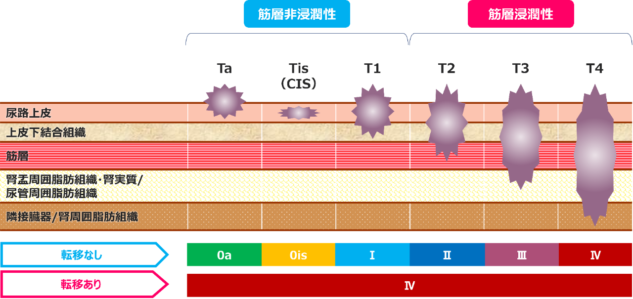 図5：腎盂・尿管癌のStage分類
