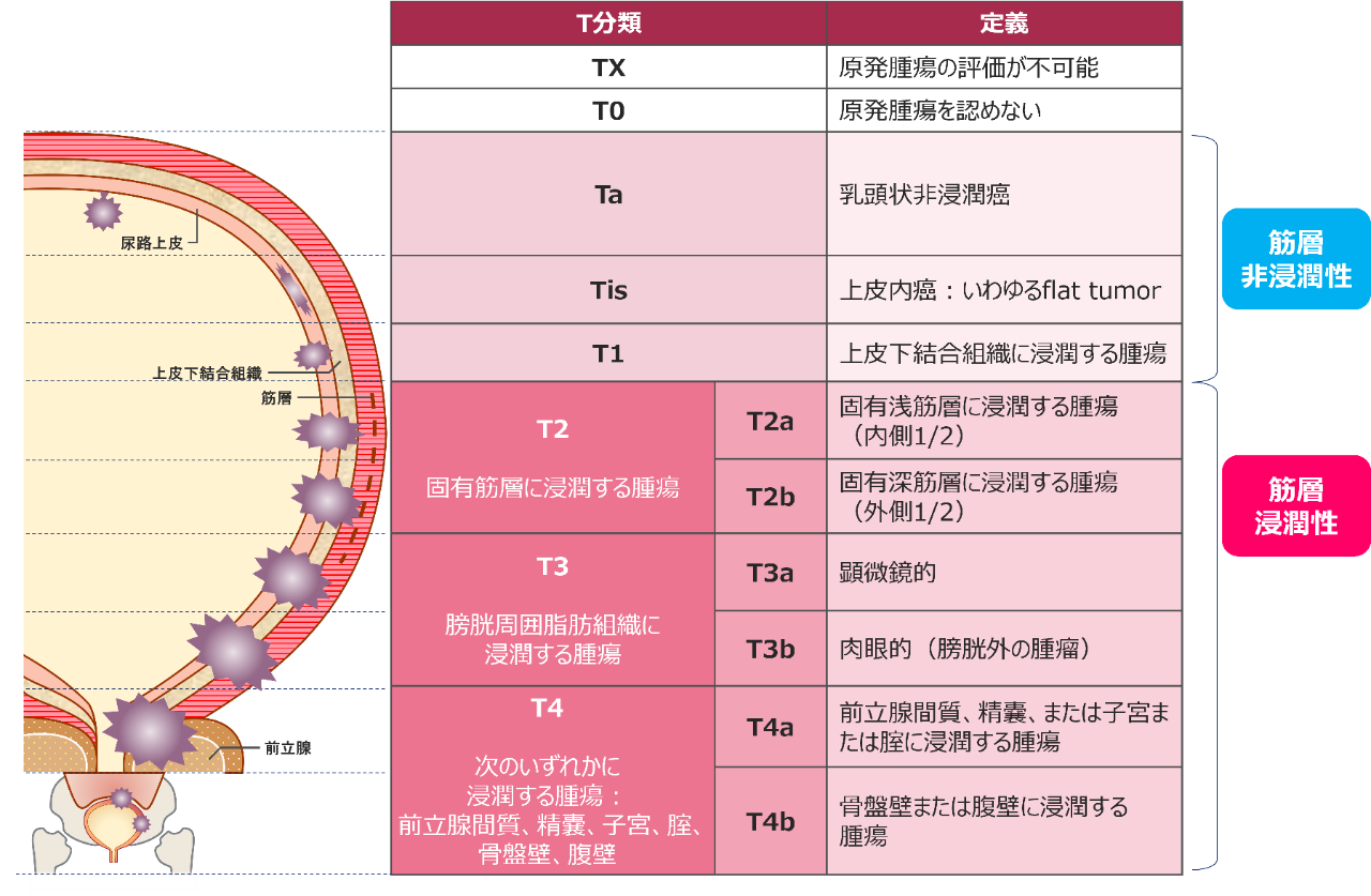図1：膀胱癌のT分類